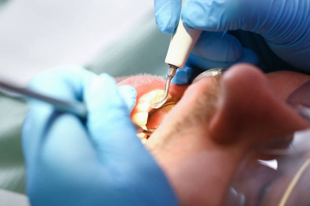 Best Emergency Treatment for Dental Infections or Abscesses in Prichard, AL