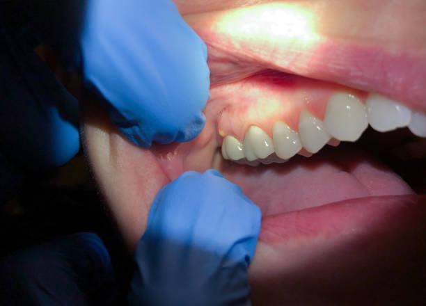 Best Emergency Treatment for Dental Infections or Abscesses in Prichard, AL